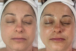 BB Glow treatment After and Before