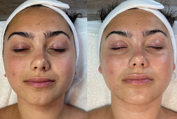 BB Glow treatment Before and After