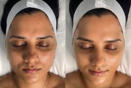 BB Glow treatment 8 Before and After BB Glow treatment