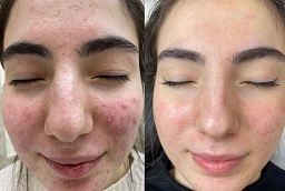 Before and After Green Peels