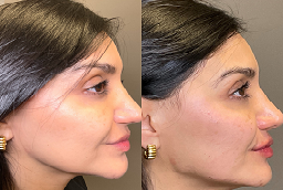 Before and After Jawline Contouring