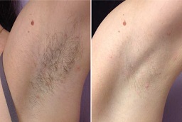 Before and After Laser Hair Removal