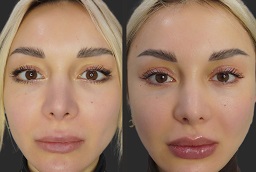 Before and After Russian Lip Filler