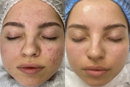 Green Peels Before and After