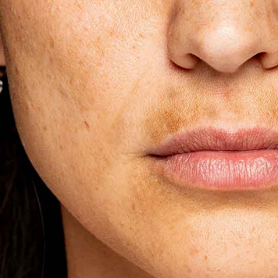 How to Remove Skin Pigmentation
