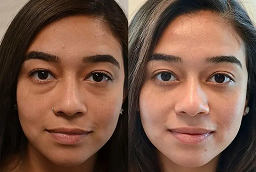 HydraFacial Abu Dhabi 7 Hydrafacial After and Before