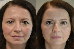 HydraFacial Abu Dhabi 8 Hydrafacial Before and After