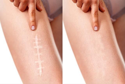 Hypertrophic Scar Removal Before anf After