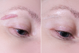 Hypertrophic Scar Removal after anf before