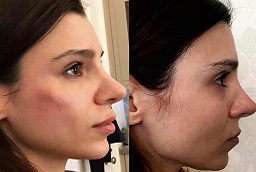 Jawline Contouring After and Before