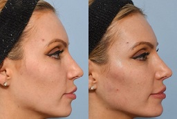 Jawline Contouring Before and After