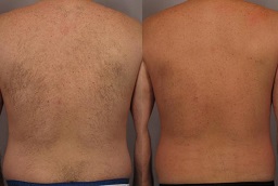 Laser Hair Removal After and Before