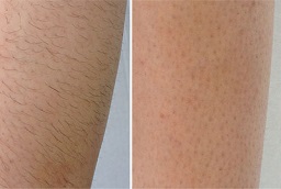 Laser Hair Removal Before and After