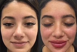 Russian Lip Filler Before and After