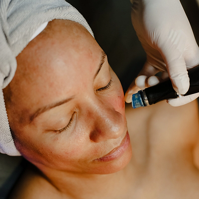 What Does a HydraFacial Do for Your Face? 9 What Does a HydraFacial Do for Your Face?