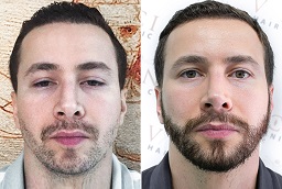 Beard Hair Transplant 7 Beard Hair Transplant Before and After