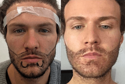 Beard Hair Transplant 8 Before and After Beard Hair Transplant