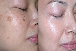Dermal Pigmentation 8 Before and After Dermal Pigmentation