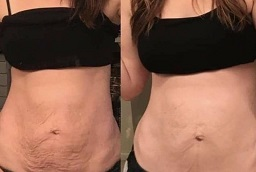 Before and After Laser Lipolysis
