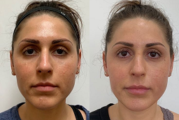 Before and After PCA Peel Treatment