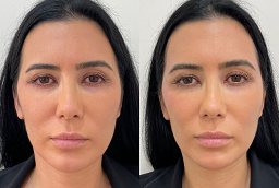 Before and After PRP Treatment