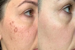 Dermal Pigmentation After and Before