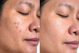 Dermal Pigmentation Before and After