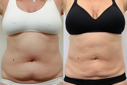 Lipolysis Treatment 8 Lipolysis Treatment After and Before