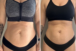 Lipolysis Treatment Before and After
