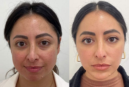 PCA Peel Treatment After and Before