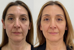 PCA Peel Treatment Before and After