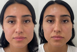 PRP Treatment After and Before