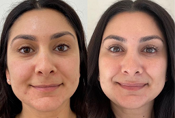 PRP Treatment Before and After