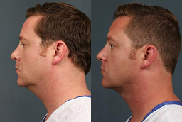 Before and After Neck Lift Surgery