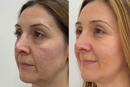 Pico Laser Treatment 8 Before and After Pico Laser Treatment