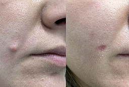Mole Removal After and Before