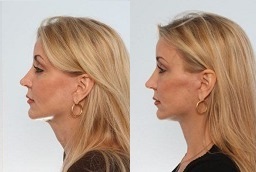 Neck Lift Surgery After and Before