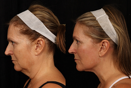 Neck Lift Surgery 8 Neck Lift Surgery Before and After