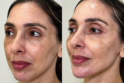 Pico Laser Treatment After and Before
