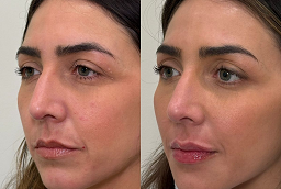 Pico Laser Treatment Before and After