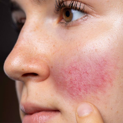 What Treatments Help Relieve Rosacea