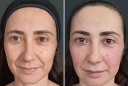 Before and After Non-Surgical Facelift