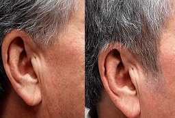 Before and After Sideburn Hair Transplant Before and After