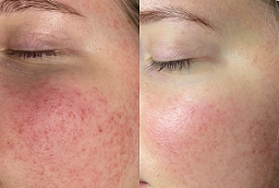 Subcision Treatment for Acne Scar 8 Before and After Subcision Treatment for Acne Scar