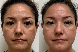 Before and After Ultherapy