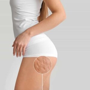 Blog 3 Can Fat Transfer Surgery Reduce Cellulite