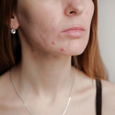Can Hormonal Acne Be Cured?