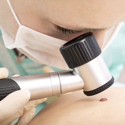 Dermoscopy Mole Evaluation 2 Dermoscopy Mole Evaluation in Abu Dhabi