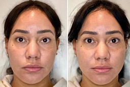 Non-Surgical Facelift 8 Non-Surgical Facelift After and Before