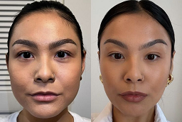 Non-Surgical Facelift Before and After